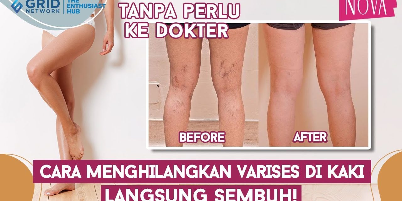 Waspada Varises Sejak Dini, Gangguan Pembuluh Darah Vena