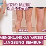 Waspada Varises Sejak Dini, Gangguan Pembuluh Darah Vena