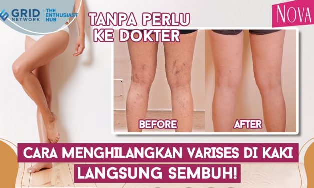 Waspada Varises Sejak Dini, Gangguan Pembuluh Darah Vena