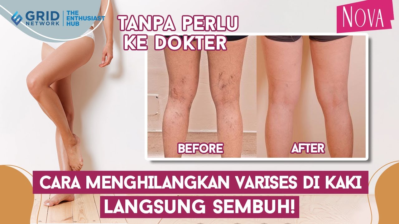 Waspada Varises Sejak Dini